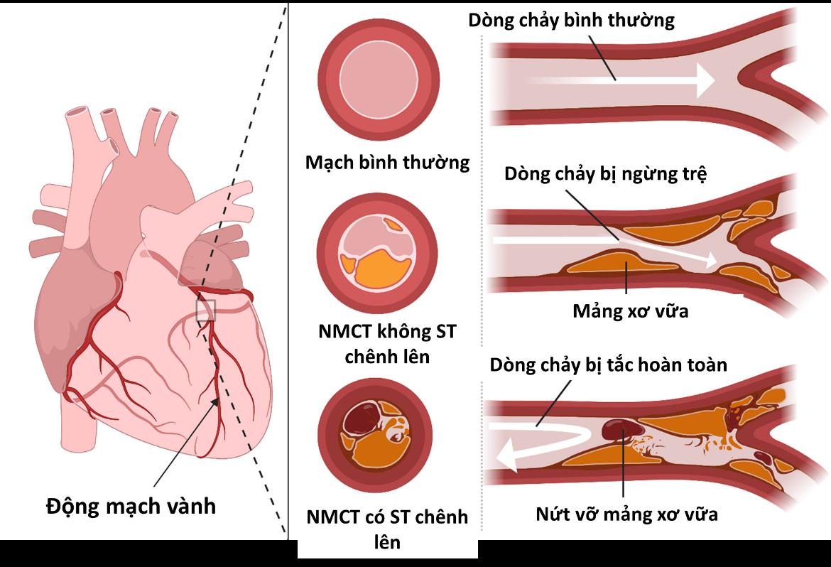 Triệu chứng nhồi máu cơ tim