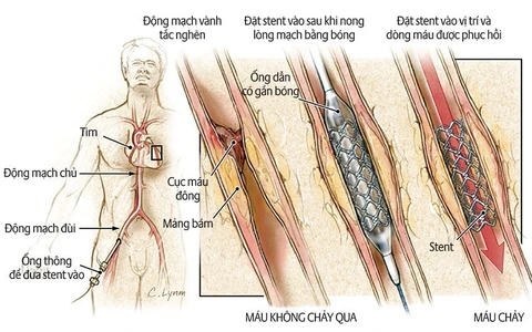 Tầm quan trọng của việc phát hiện và điều trị kịp thời