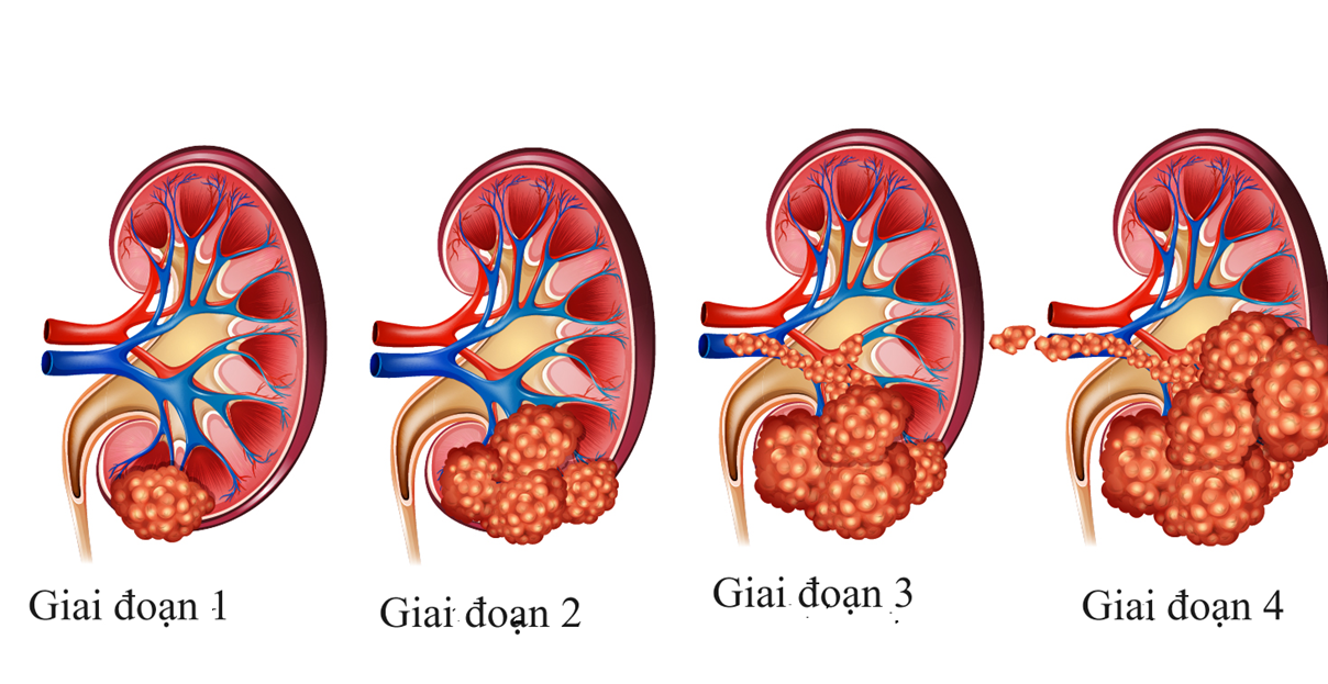 Chẩn đoán ung thư thận